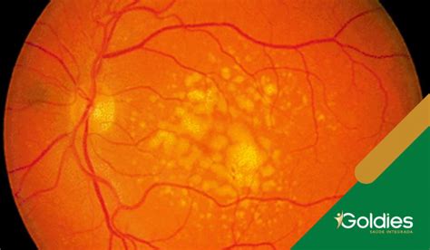 Degeneração Macular Relacionada A Idade - Degeneração Macular Relacionada À Idade (DMRI) - Goldies Saúde Integrada