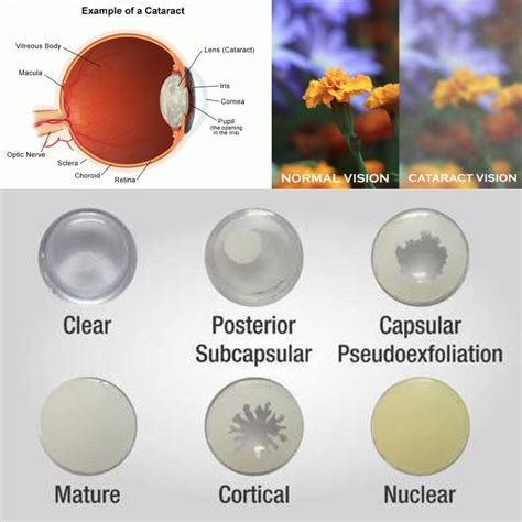 Treatment And Management Of Ocular Disease Hodes Vision Optometry