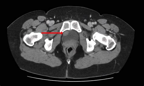 CT urogram (axial view) revealing a 1.5 cm thickening at the level of ...