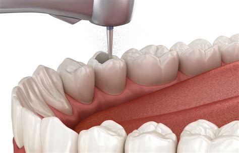 Affordable Root Canal In Camberley Surrey Coppertop Dental