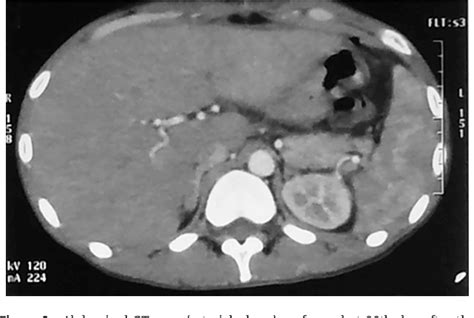 Figure 1 From Miliary Abscess Of The Liver Unusual Complication Of Intestinal Perforation