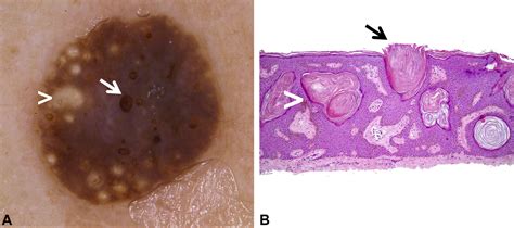 Dermoscopy And Dermatopathology Correlates Of Cutaneous Neoplasms