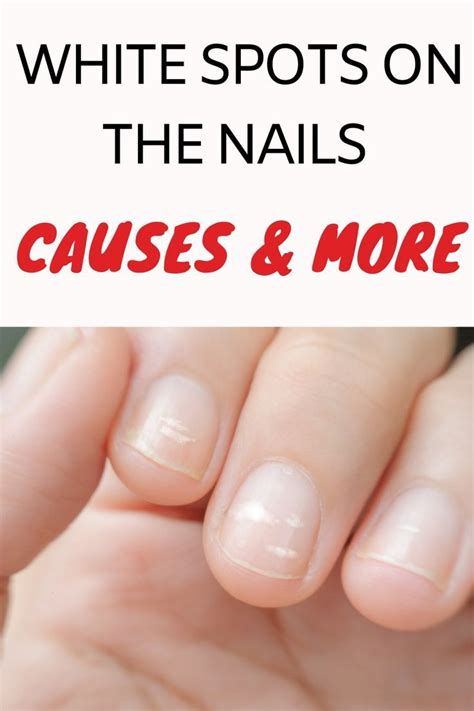 White Spots On Your Nails Artofit