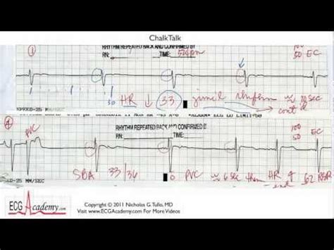 Ecg Interpretation Ecg Electrode Misplacement Part Video