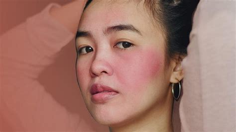 Kenalan Dengan Rosacea Dan 6 Kebiasaan Sehari Hari Yang Jadi Pemicu