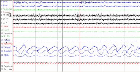 Obstructive Sleep Apnea Article