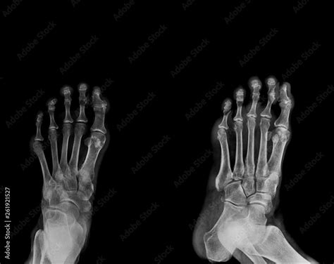 Foot X Ray Ap And Lateral View Stock Photo Adobe Stock