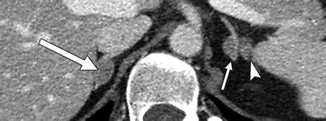 Differentiation Of Adrenal Hyperplasia From Adenoma By Use Of Ct Densitometry And Percentage