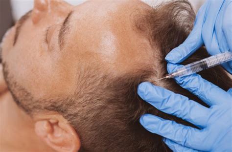 Prp For Hair Loss Medical Spa And Cosmetic Center