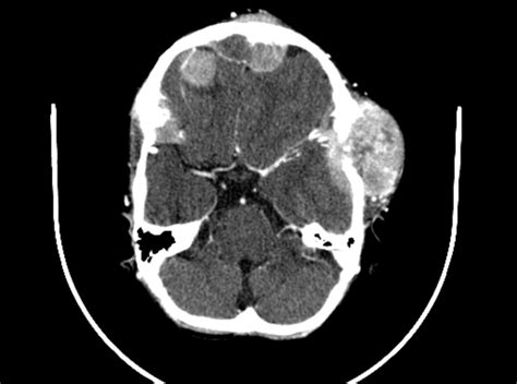 Neuroblastoma Ct Wikidoc