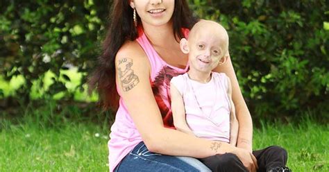 Doença Que Nasce Velho E Fica Novo - G1 - Doença rara faz britânica de 8 anos ter corpo de idosa - notícias ...