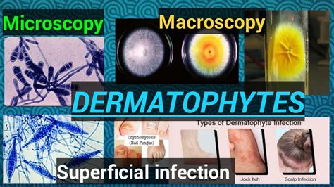 Fungal Infection Fungal Culture Fungal Identification Dermatophytes