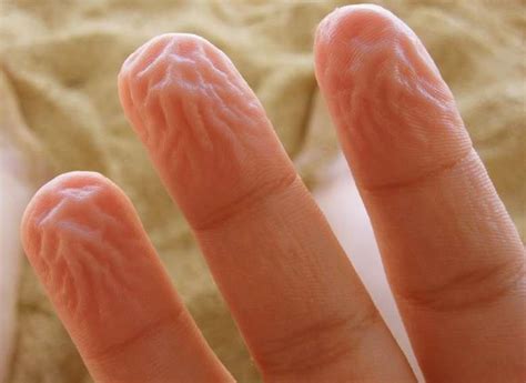 wrinkled fingertips  treatment pain redness lupus thyroid