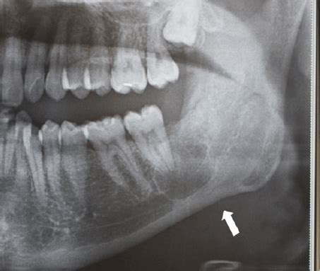 Pathological Fracture Mandible