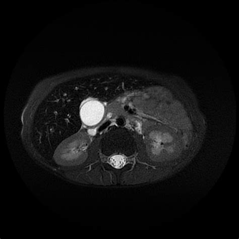 Choledocholithiasis With Biliary Obstruction And Obstructive Jaundice