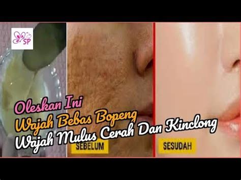 Tips Manjur Inilah Cara Menghilangkan Bopeng Bekas Jerawat Di Wajah