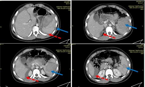 Abdominal Ct There Is An Intraparenchymal Hematomalaceration