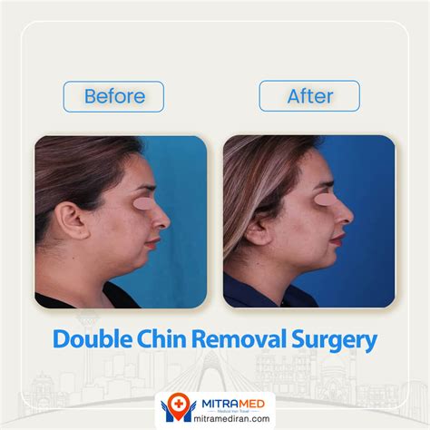 Double Chin Surgery in Iran | Double Chin Removal | MITRAMED