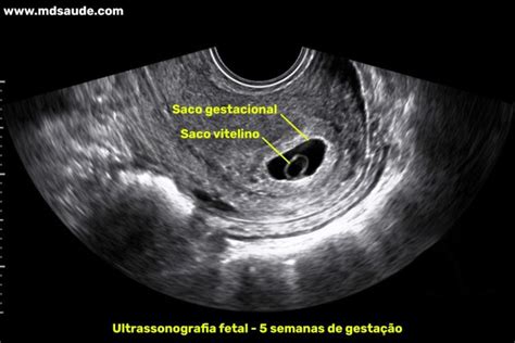 5 Semanas E 4 Dias De Gravidez - 5 semanas de gravidez | Gestação semana a semana