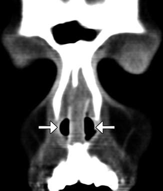 Floor Of The Nasal Cavity Radiograph