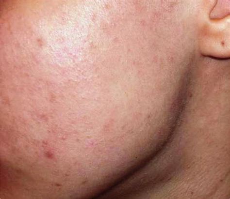 Mild Acne On Chin