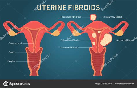 Uterine Fibroids Scheme On Dark Blue Background Stock Vector Image By