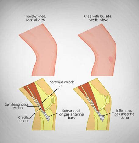 toronto  leg physiotherapy call  push pounds