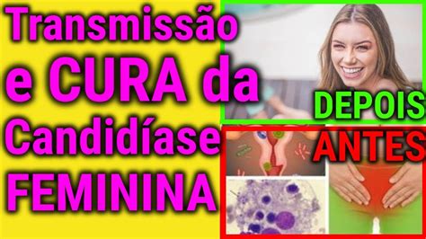 candidiase transmissao veja como curar candidiase feminina - YouTube