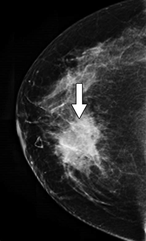 Granulomatous Mastitis