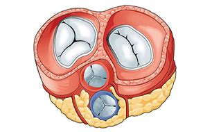 Heart Valve Disease - Mitral Valve Stenosis – SOFMEDICA.com