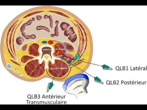 Anatomie carré des lombes QLB Lanesthésie locorégionale ALR