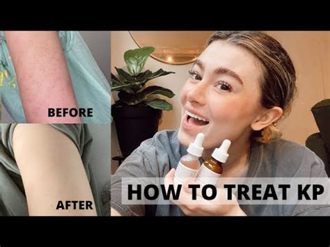 how to get rid of kp