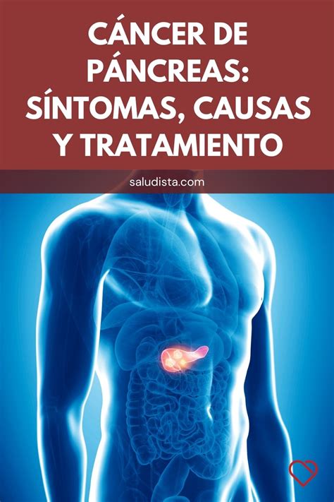 Cancer De Pancreas Sintomas Y Signos