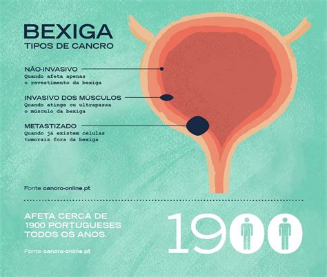 Sintomas De Bexiga Perfurada - RETOEDU