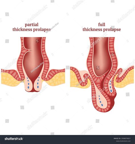 Prolapsed Internal Hemorrhoid