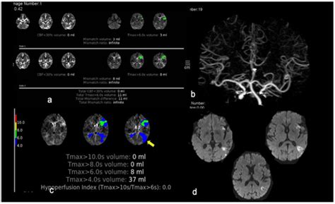 Jcm Free Full Text Advanced Neuroimaging Preceding Intravenous