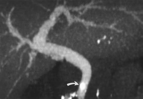 Diagnosing Bile Duct Stones Comparison Of Unenhanced Helical Ct Oral