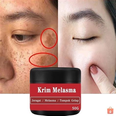 sale krim melasma krim jeragat  berkesan rawatan flek hitam