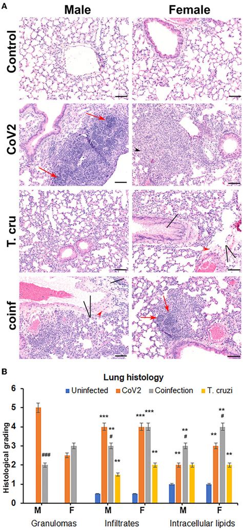 Sex Differences In Cardiac Pathology Of Sars Cov Infected And Trypanosoma Cruzi Co Infected