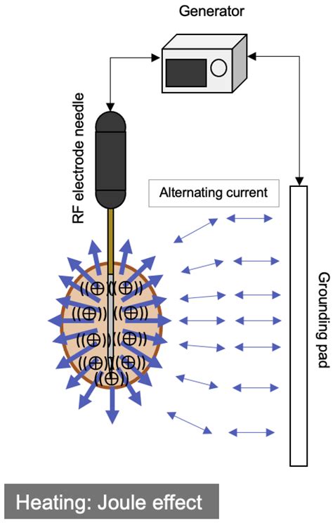 Tumor Thermal Ablation Enhancement By Micromaterials – PJLM
