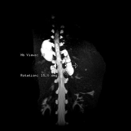 Lateral Thoracic Meningocele Radiology Reference Article