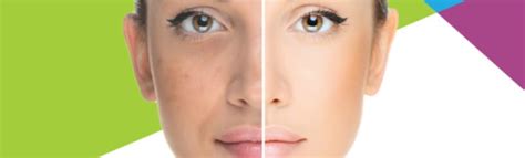 IPL acne treatment - Laser Tattoo Removal Brisbane with PicoSure®