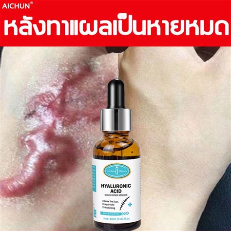 Scar Acne Marks Remover Serum Peklat And Keloid Scarminator Cream Treat