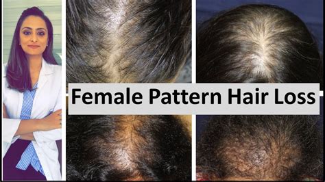 Hair Loss In Women Female Pattern Hair Loss Causes And Treatment Dermatologist Youtube