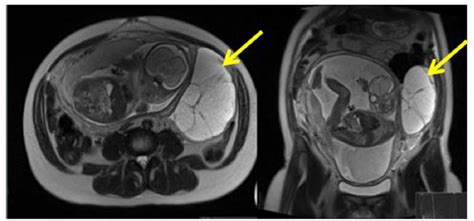 Figure 1 From Rare Tumours In Pregnancy Pictorial Review Semantic