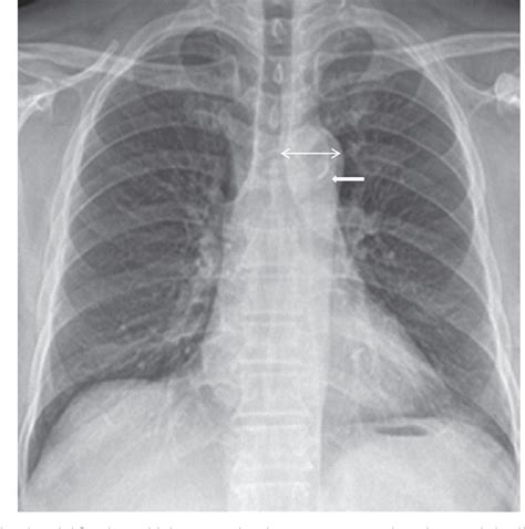 Figure 2 from The clinical significance of aortic calcification in chest radiography in ...