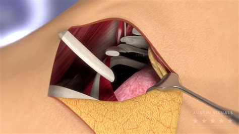 D Surgical Medical Animation Austin Visuals Youtube