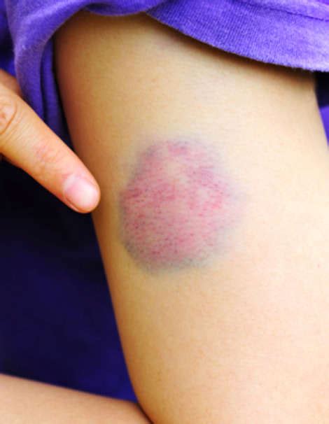 9 Weird Facts About Bruises