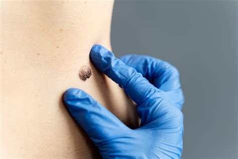 Where can I Get Painless Wart Removal Treatment