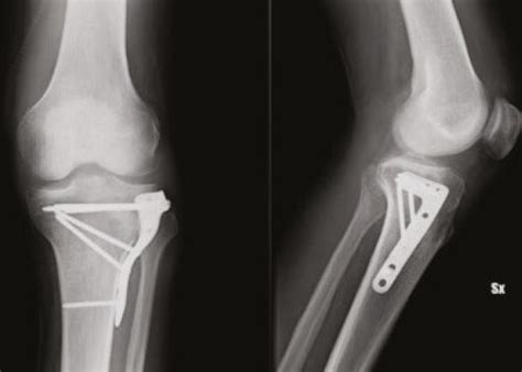 External Left Schatzker Ii Tibial Plateau Fracture